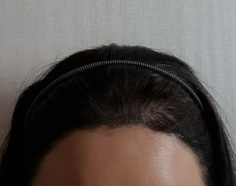 6个月的发际线
