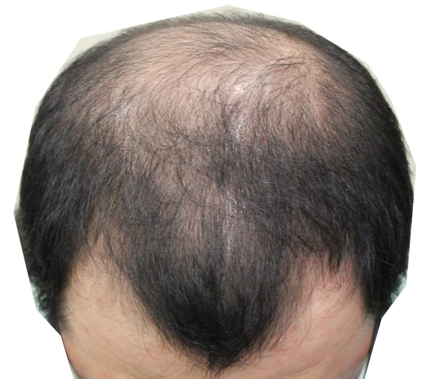[JP Hair Transplantation] JP Plastic Surgery 5,900 hair transplantation has been reviewed for a week...