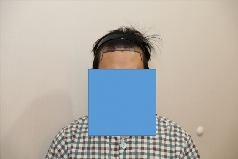 헤어라인 1700모낭 모발이식 209일차 후기