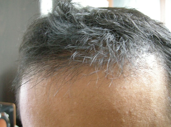 수술후이마.jpg