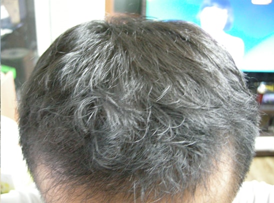 수술후4정수리.jpg