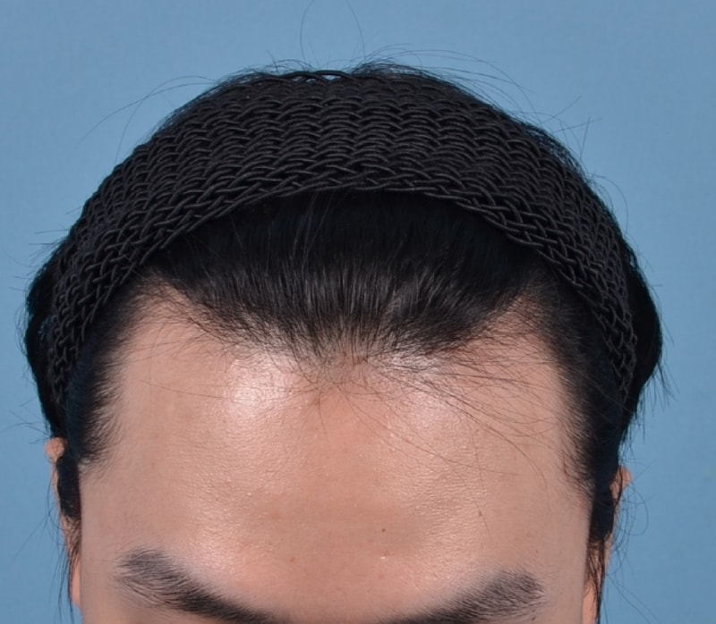 수술전.jpg