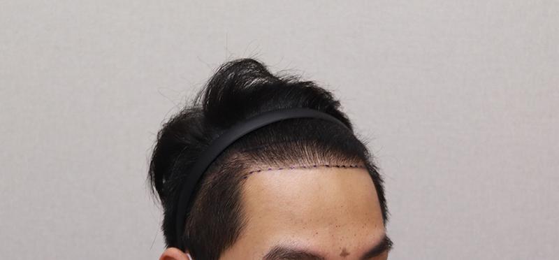 It is a review after 500 days of hair transplantation.