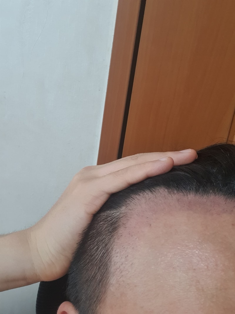 モディヘアプラント2ヶ月目~