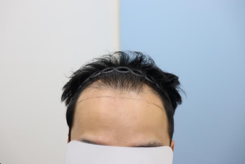 Gwangju Apgujeong Mobiang 6-month hair transplant review