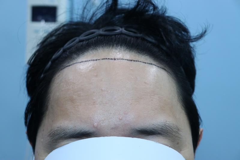 Review of 10 Months of Mobiang Hair Transplantation in Apgujeong, Gwangju