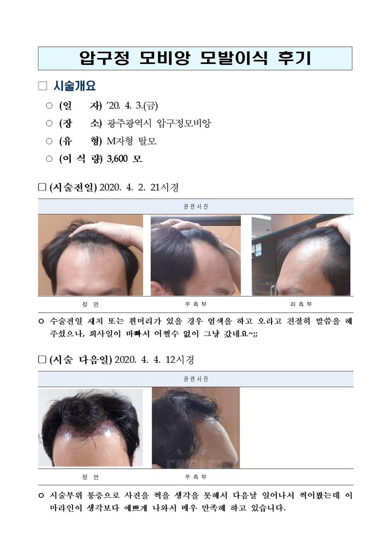 2021년 4월 15일 모발이식 1년 후기ㅎㅎㅎㅎ