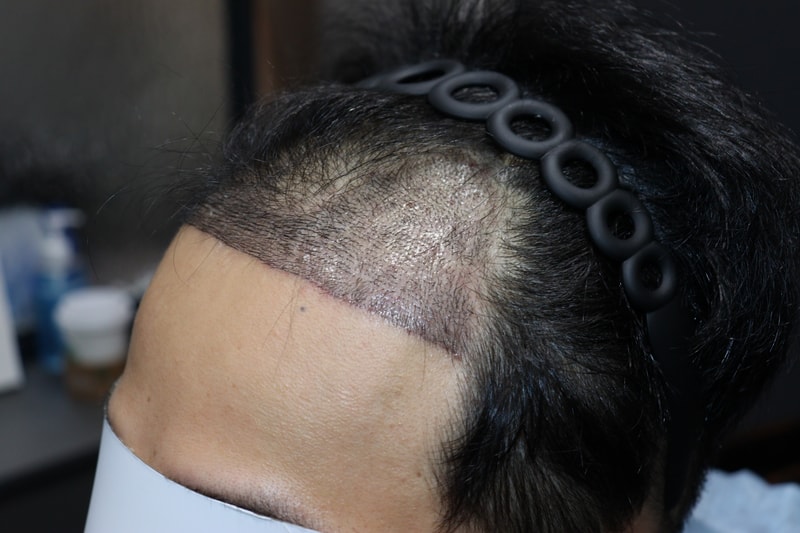 This is the review of hair transplantation in the 2nd week of Gwangju Apgujeong Mobiang