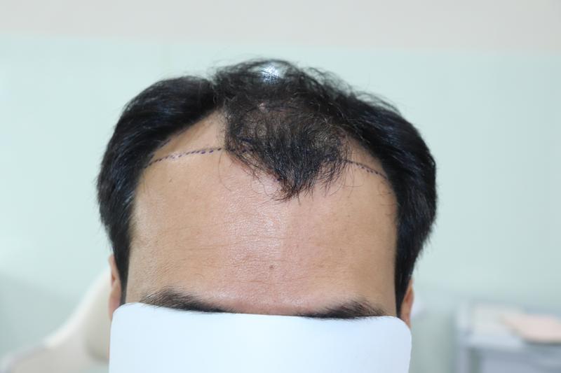 광주압구정모비앙의원 모발이식 1년경과후기
