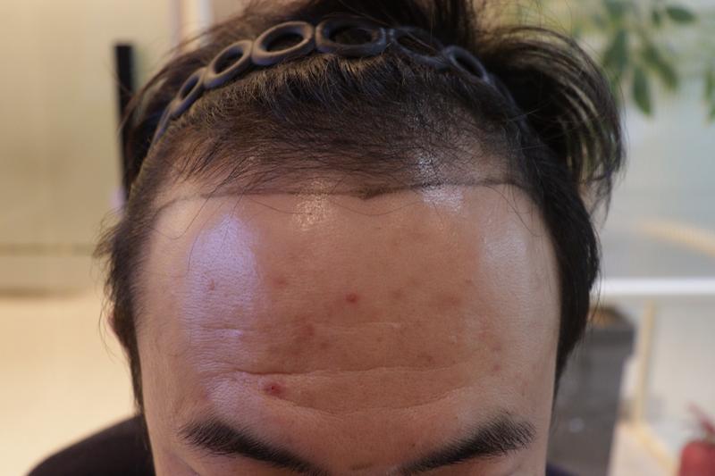 Gwangju Apgujeong Mobien hair transplant 10 months later, review