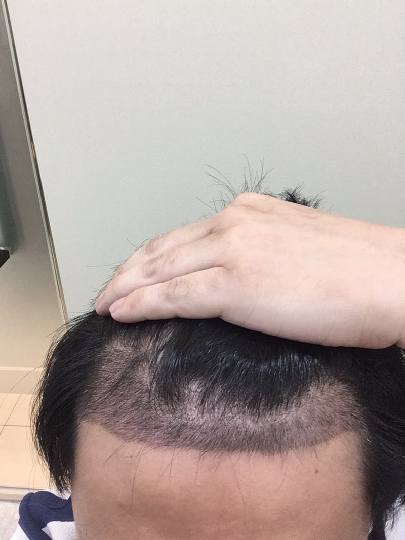 광주 압구정모비앙 10일차 모발이식 후기