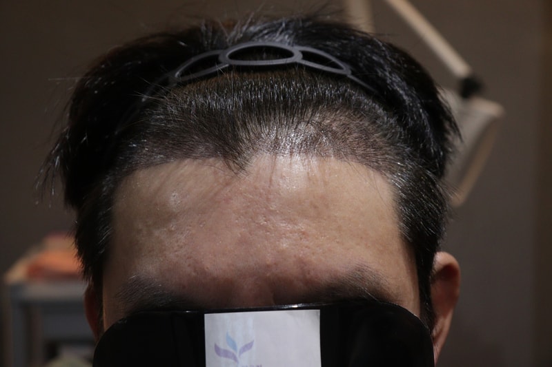 광주 압구정 모비앙의원 모발이식 2주경과 후기