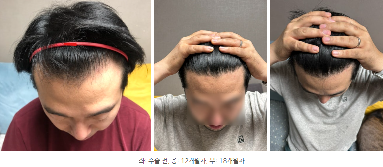 이마라인.png