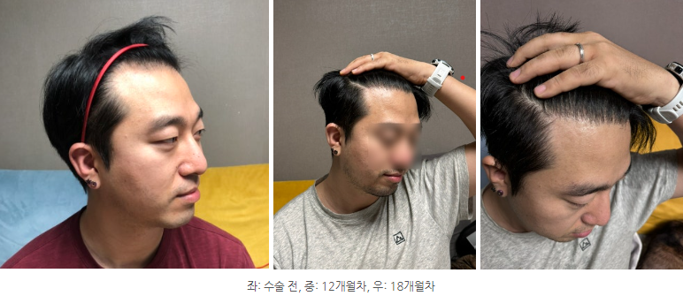 오른쪽이마라인.png