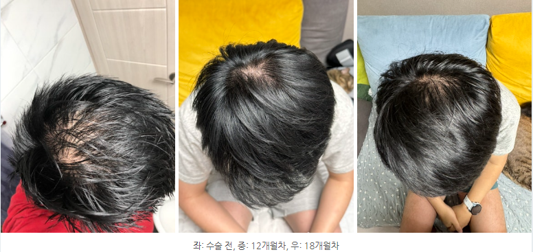 정수리.png