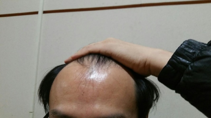 이식전#3.jpg