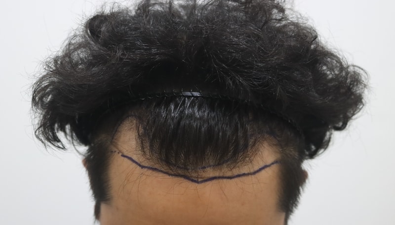 [Most Clinic] A year after surgery, a review of satisfaction