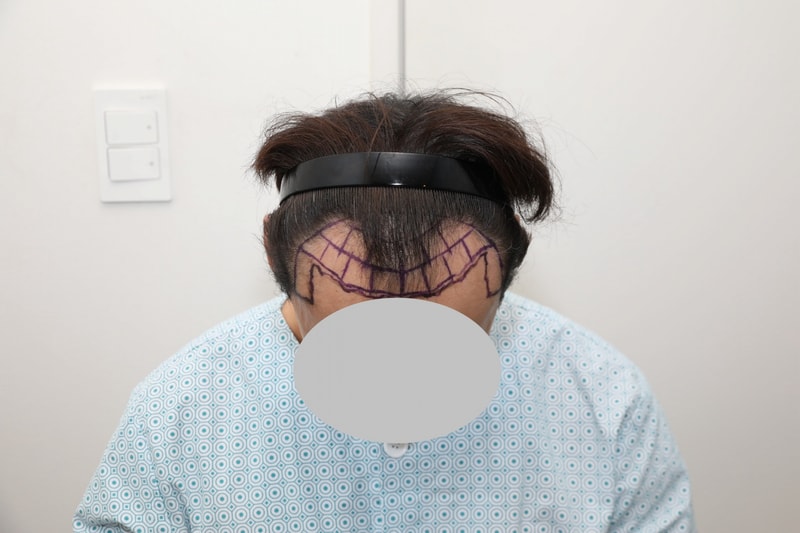 Director Kim Jin-oh of the Gangnam branch of New Hair. It's a review of the incision