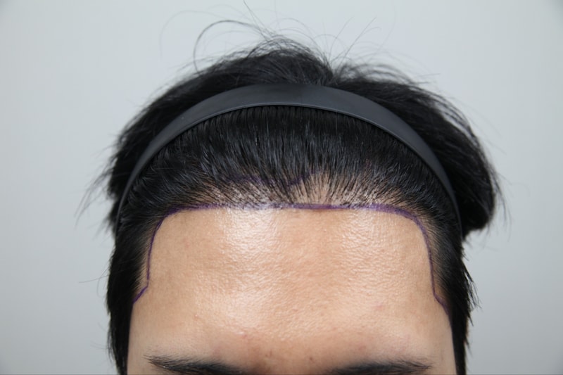 모나라피부과에서 재수술 받았네요