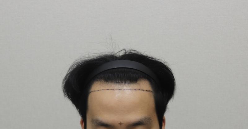 1日目 非切開 3000毛 手術後のレビュー