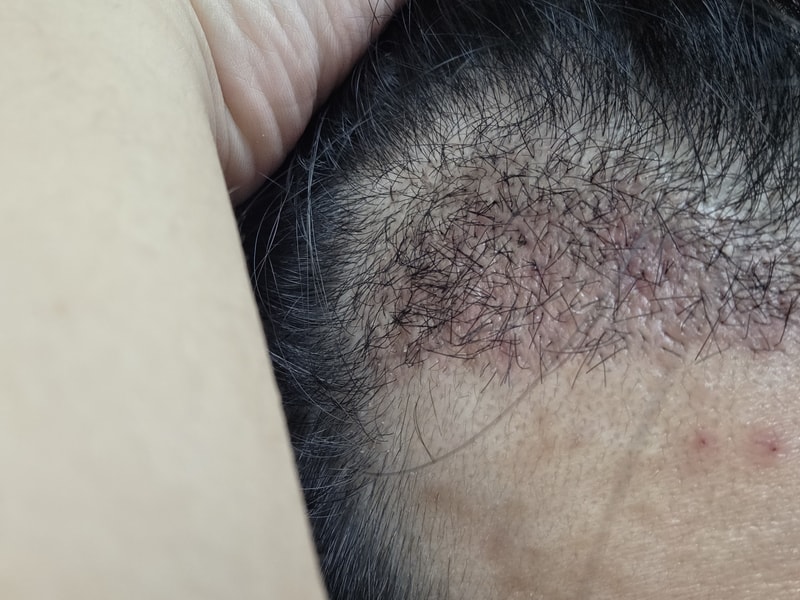 조금 늦은 모발이식 후기