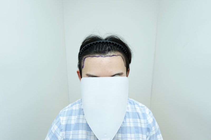 ザラダ医院 毛髪移植 1日後記