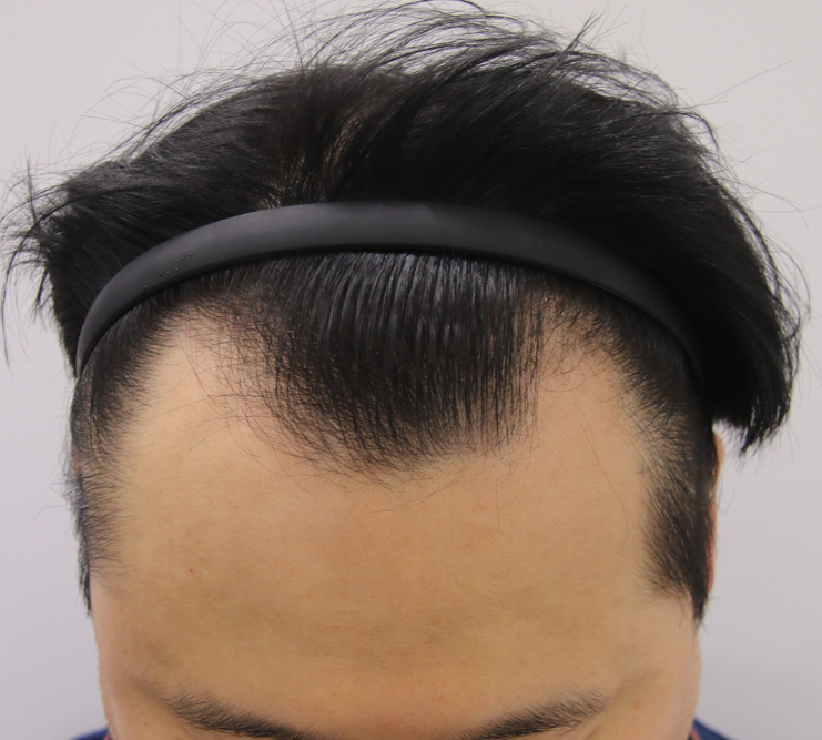 Busan Mammoth M-shaped transplant (non-cut slit) Now, it's been 10 months