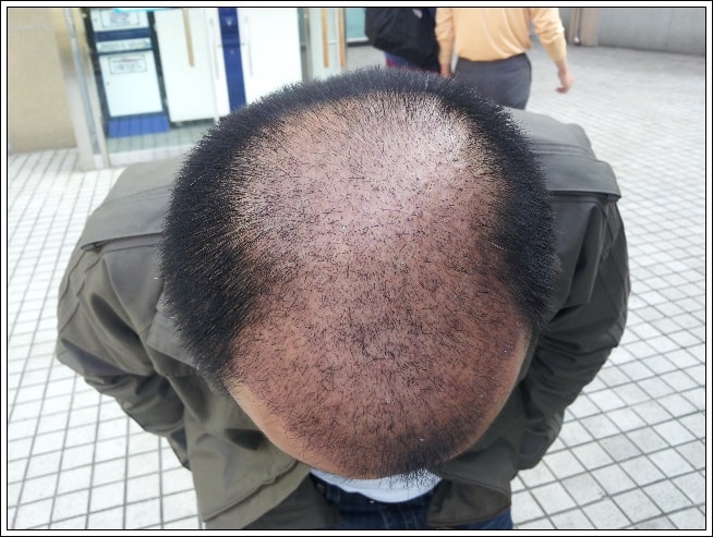 수술후27일째.jpg