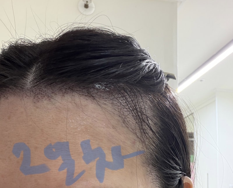 Apgujeong Mo Woo-rim clinic's review of 2,500 non-intercepts