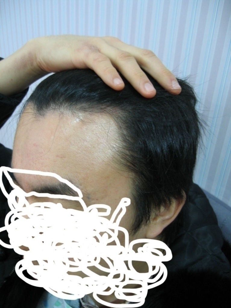 수술전좌측.jpg
