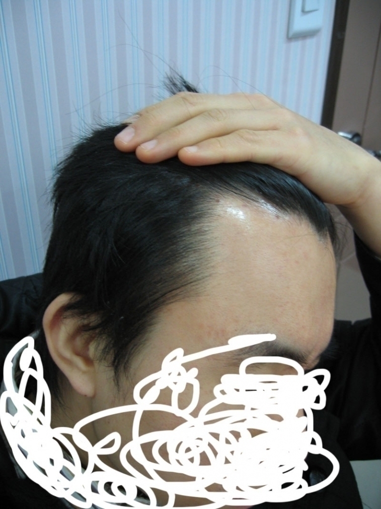 수술전우측.jpg