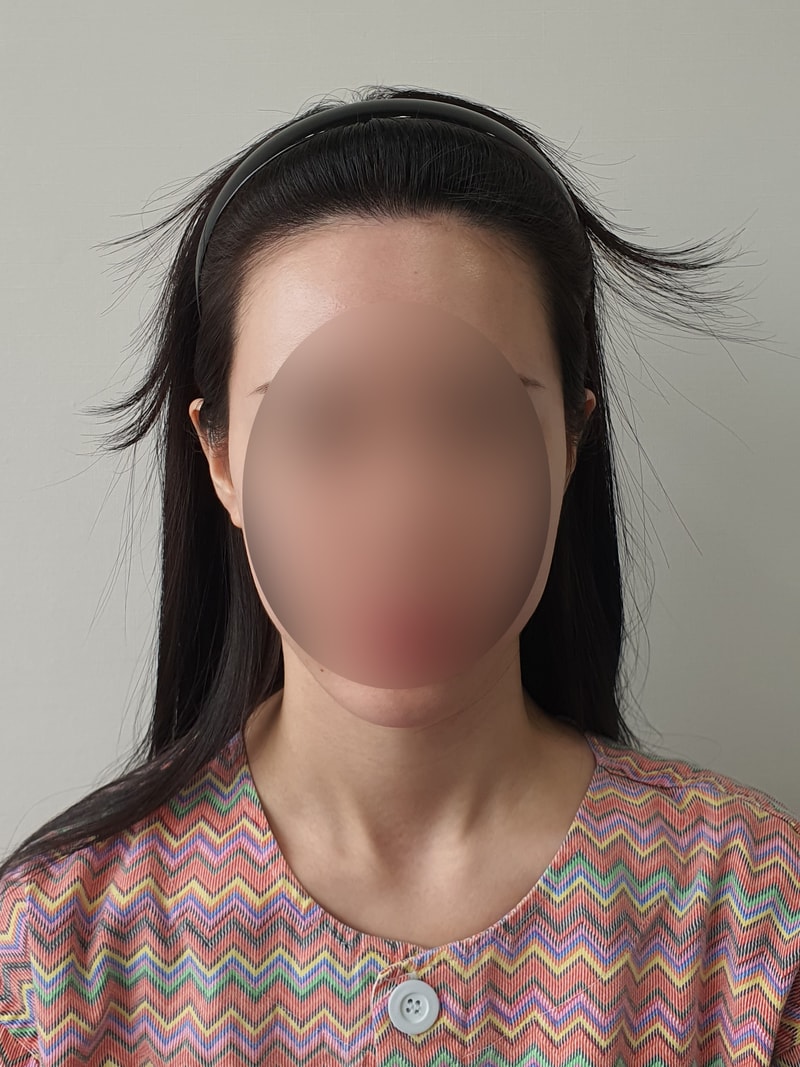 ヘアライン毛髪移植4週目のレビュー！