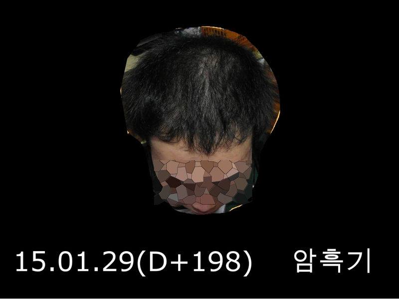 chapter #1 手术经过 第198天（2015年1月29日）