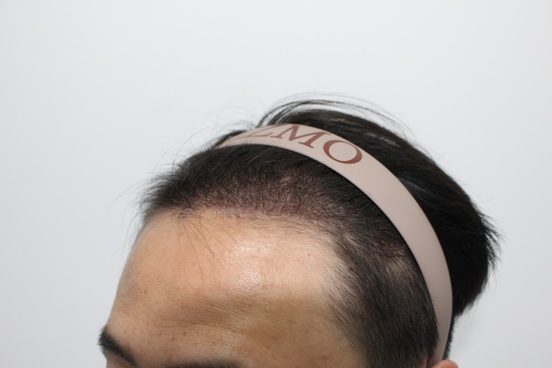 B 수술후 2주.jpg