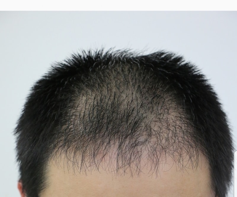 Three weeks, six weeks, right after the forehair surgery
