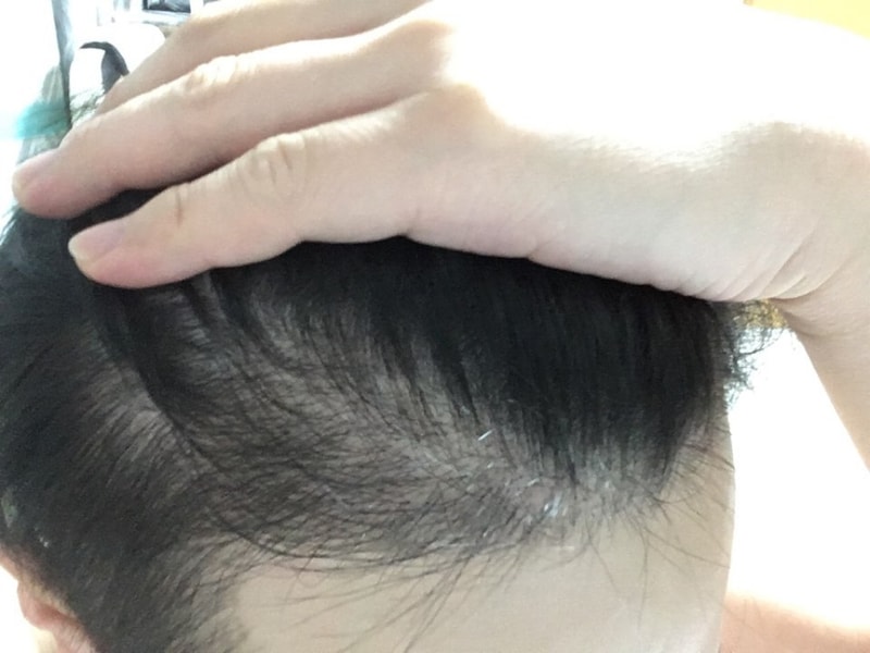 毛髪移植4ヶ月目の写真です~