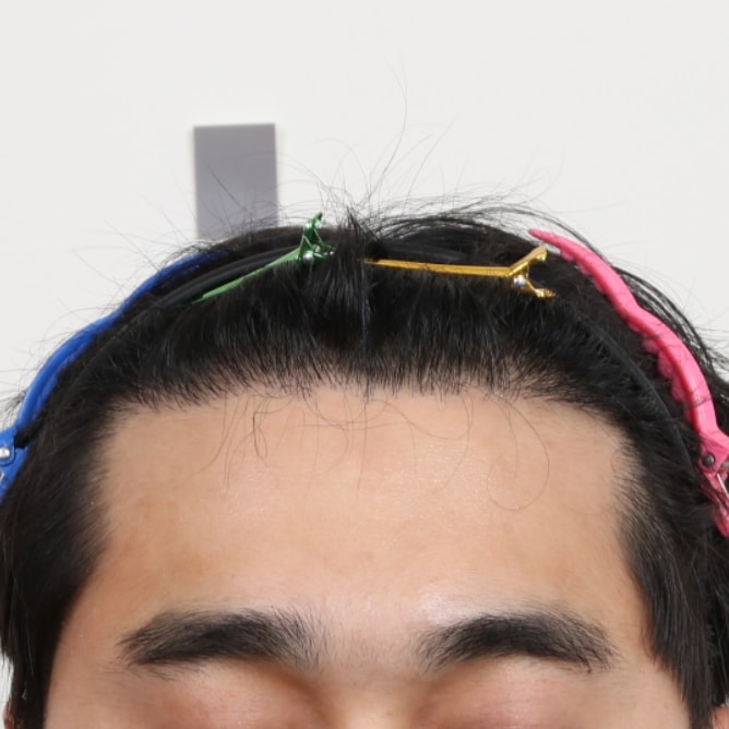 수술경과 7개월2.jpg
