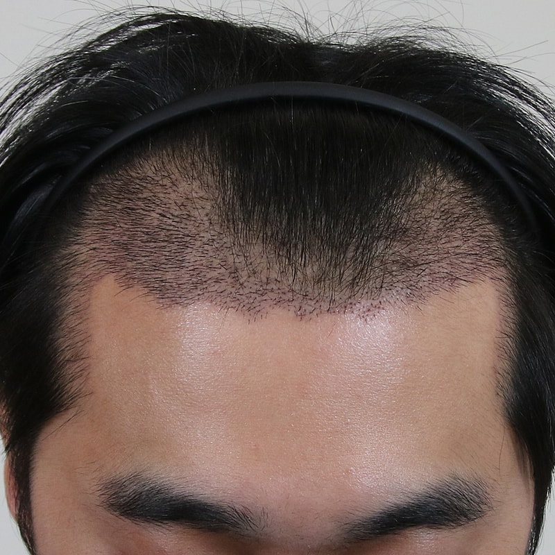 06.수술경과15일2.jpg