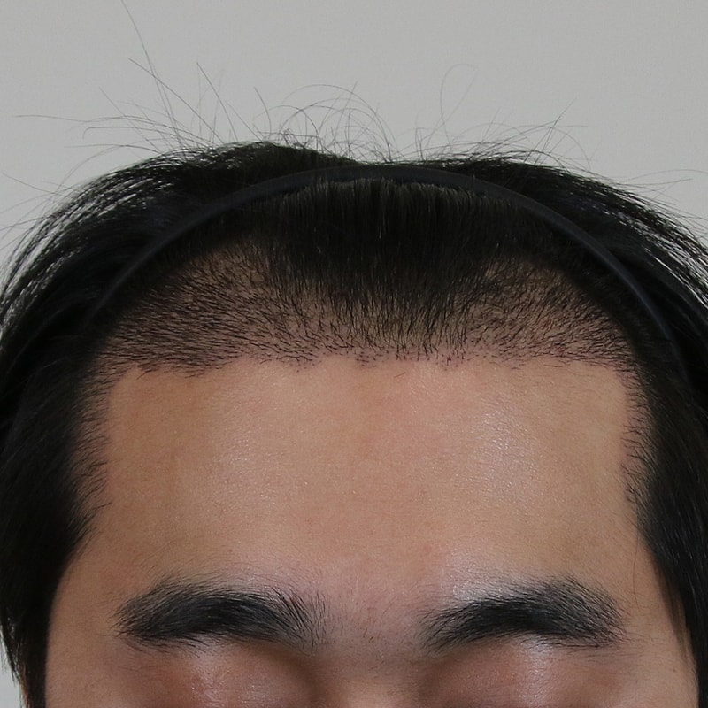 05.수술경과15일1.jpg