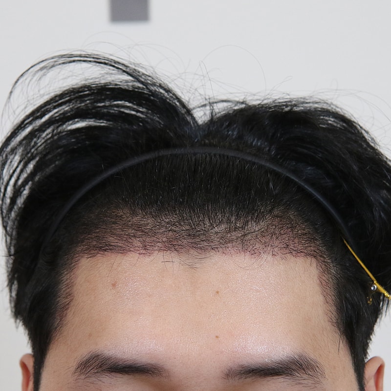 수술 2주_전병옥님.jpg