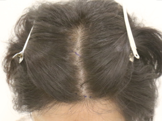 정수리 탈모로 주변에서 추천 받고 부산 맘모스에서 진행했습니다 (5개월 경과)