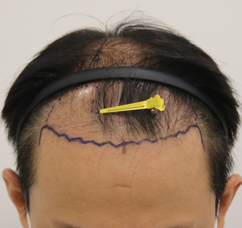수술 디자인.png