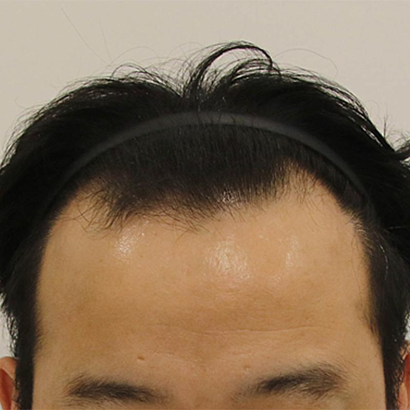 부산 맘모스에서 비절개 슬릿 모발이식 후기 (1일 경과)