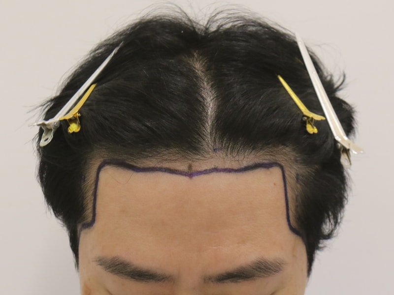 M자와 정수리 모발이식 7개월 경과