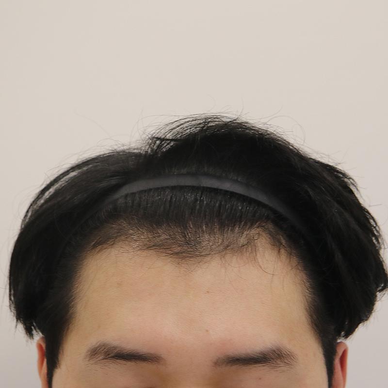 수술 전_전병옥님.jpg