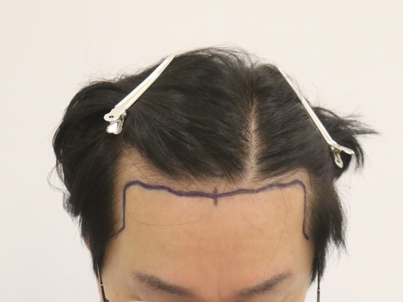 나이가 들어서 뒤늦게 받은 모발이식 5개월 후기, 부산 맘모스