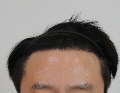 수술후.png