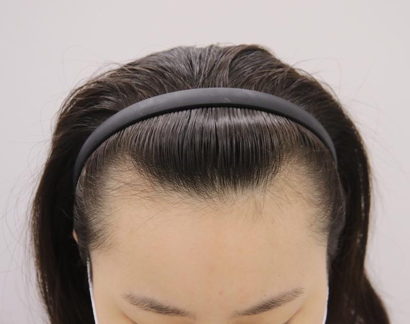 20多岁女性发际线矫正 1年3个月后的后期