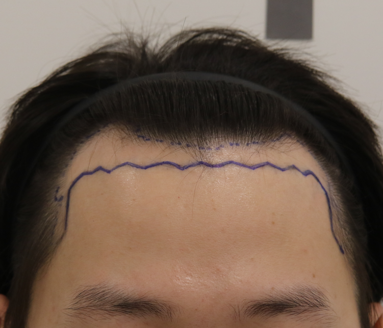 수술 디자인.png