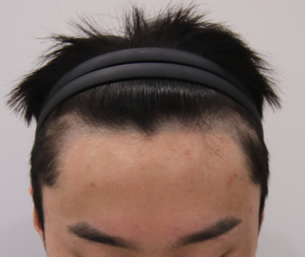 克服先天性宽额头的现任健身教练
